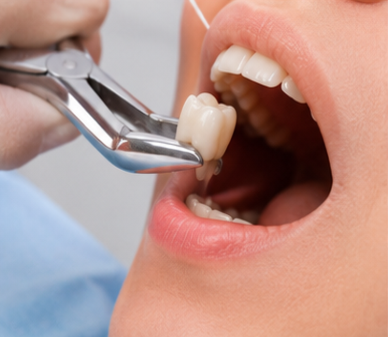 Tooth Extraction